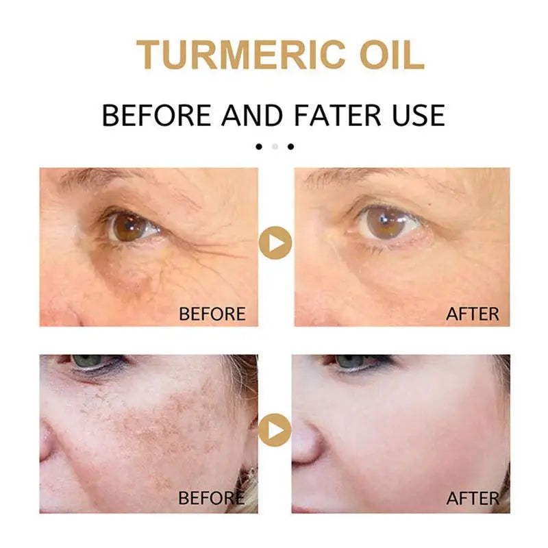 Turmeric Freckle Whitening Serum Fade Dark Spots Removal Pigment Melanin Correcting Facial Beauty Face Skin Care Products 30ml - SajiDeals