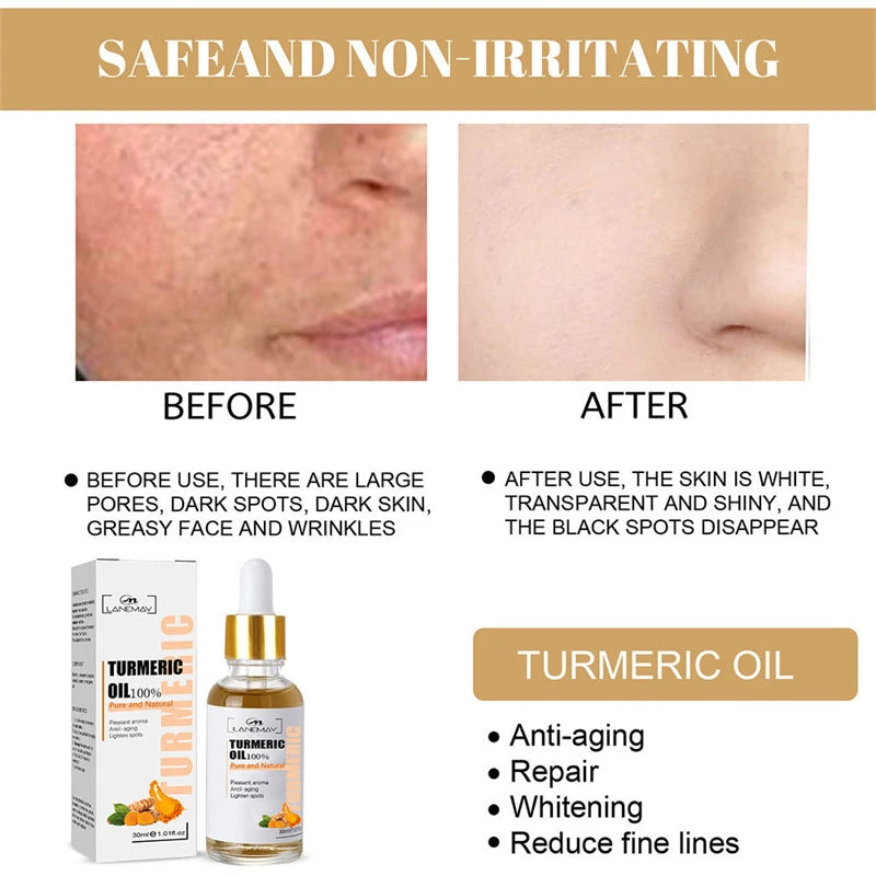 Turmeric Freckle Whitening Serum Fade Dark Spots Removal Pigment Melanin Correcting Facial Beauty Face Skin Care Products 30ml - SajiDeals